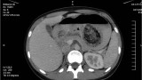 Rycina 1. Obrazy z badania TK jamy brzusznej ukazujące bezoar w świetle żołądka/ Figure 1. CT scan images showing gastric bezoar
